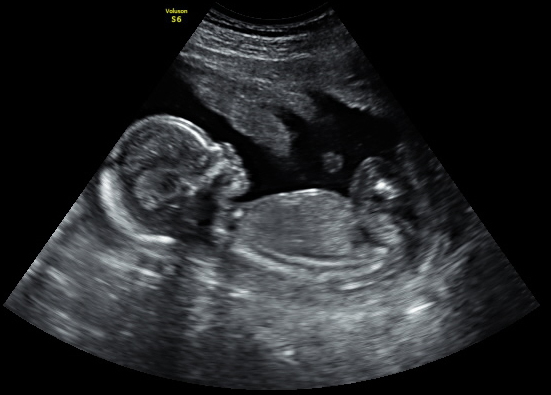 2D ultrasound