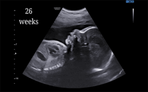 26 Weeks