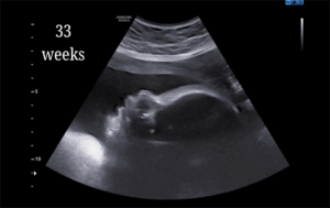 33 Weeks
